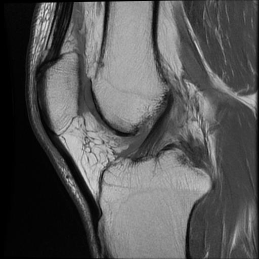 MRI Normal ACL